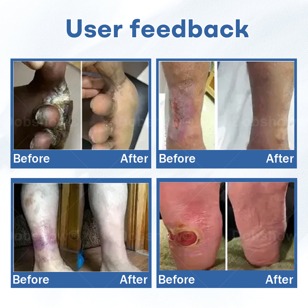 `Healrize®  Diabetic Foot Uicer Healing Cream