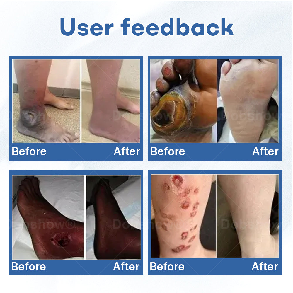 `Healrize®  Diabetic Foot Uicer Healing Cream