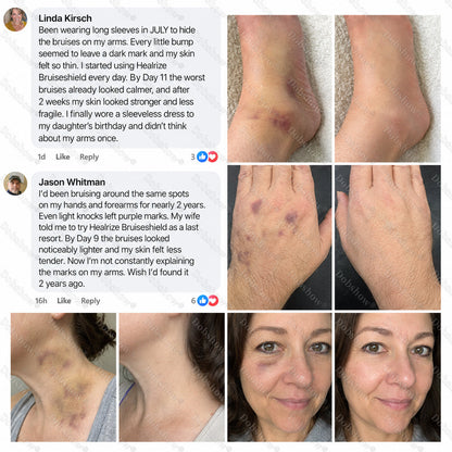 🔥89K+SOLD🔥Dobshow® BruiseShield Skin Strengthening Cream🎉Limited-time discount